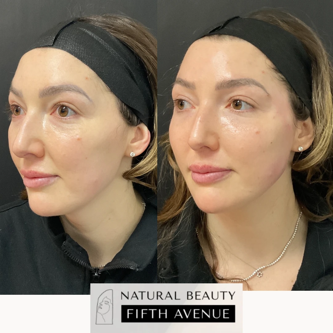 Before and after dermal fillers treatment showing patient's profile and front view with enhanced facial contours
